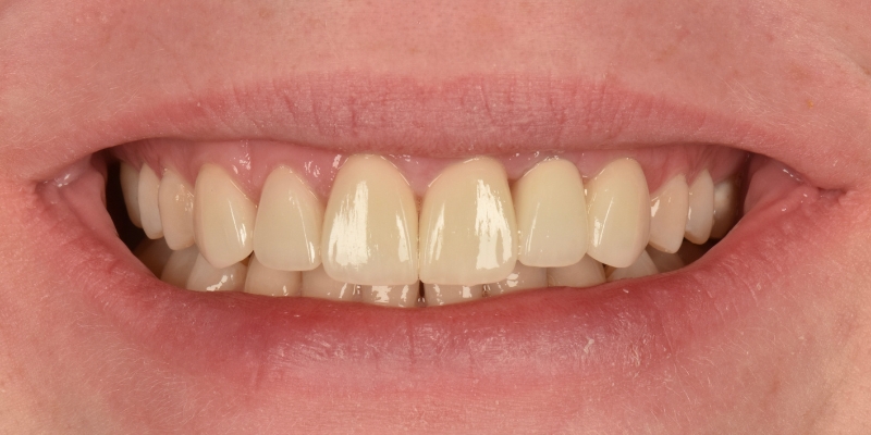 Implant_After_1