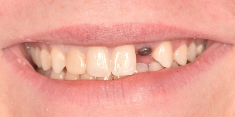 Implant_Before_2