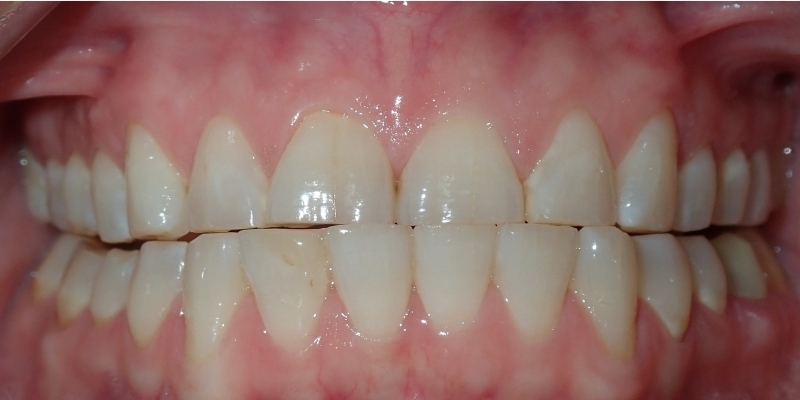 Veneers_Close_Before