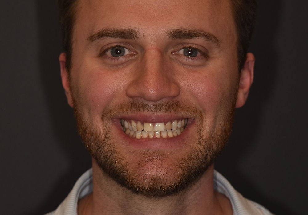 after veneers