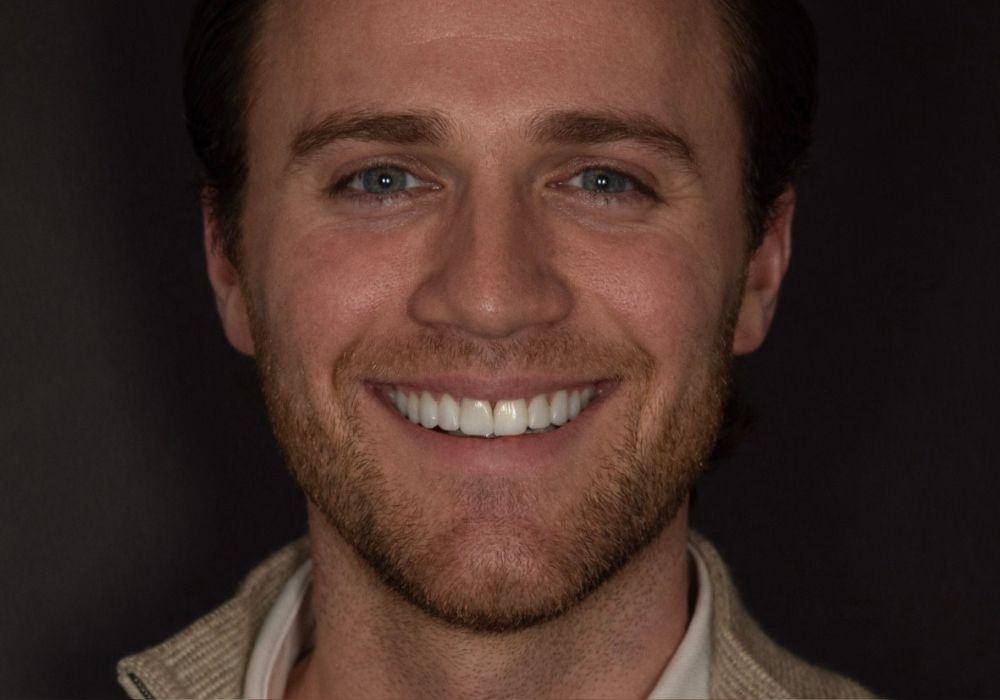 after veneers(1)